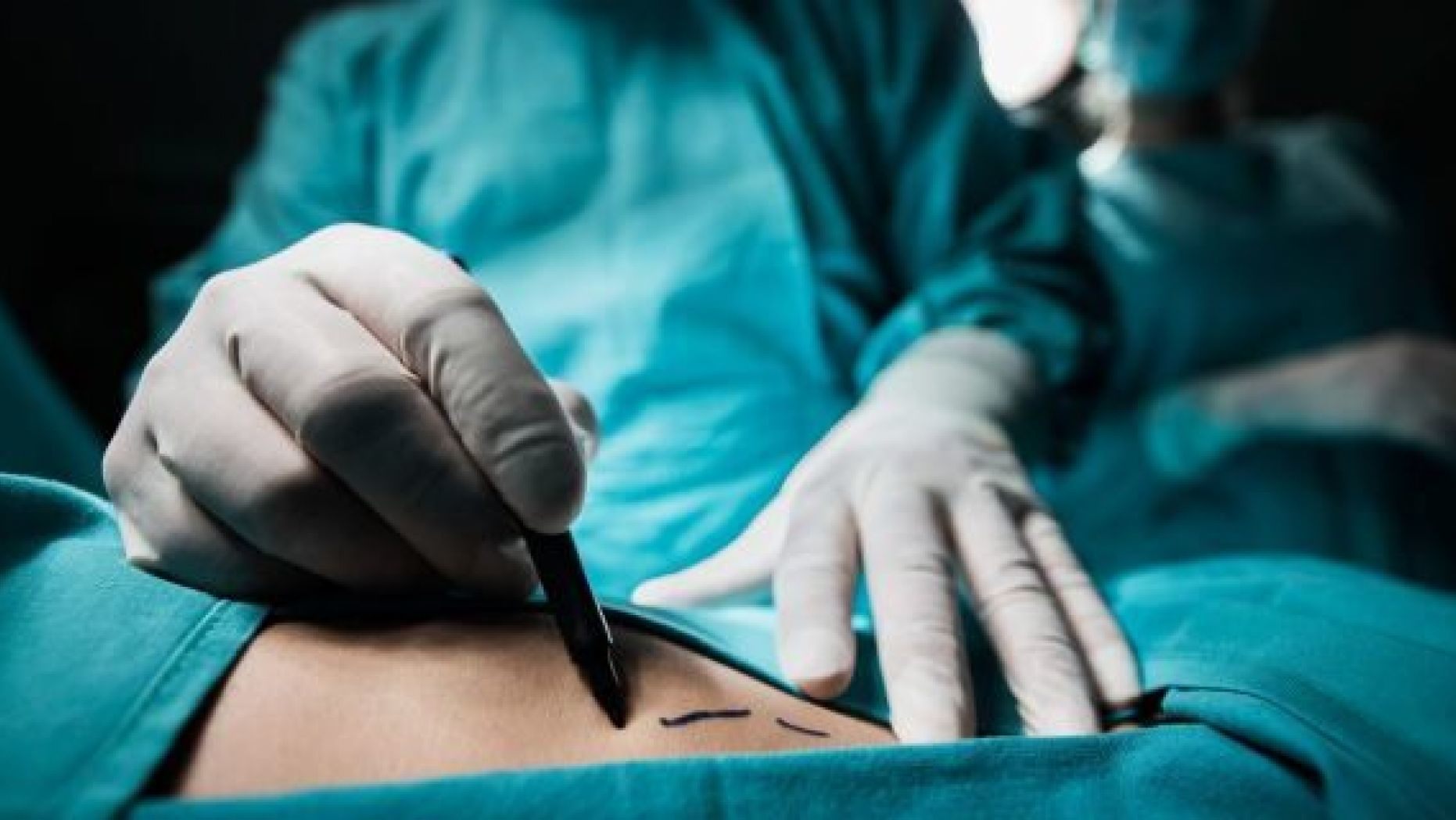 Liposuction Surgeon